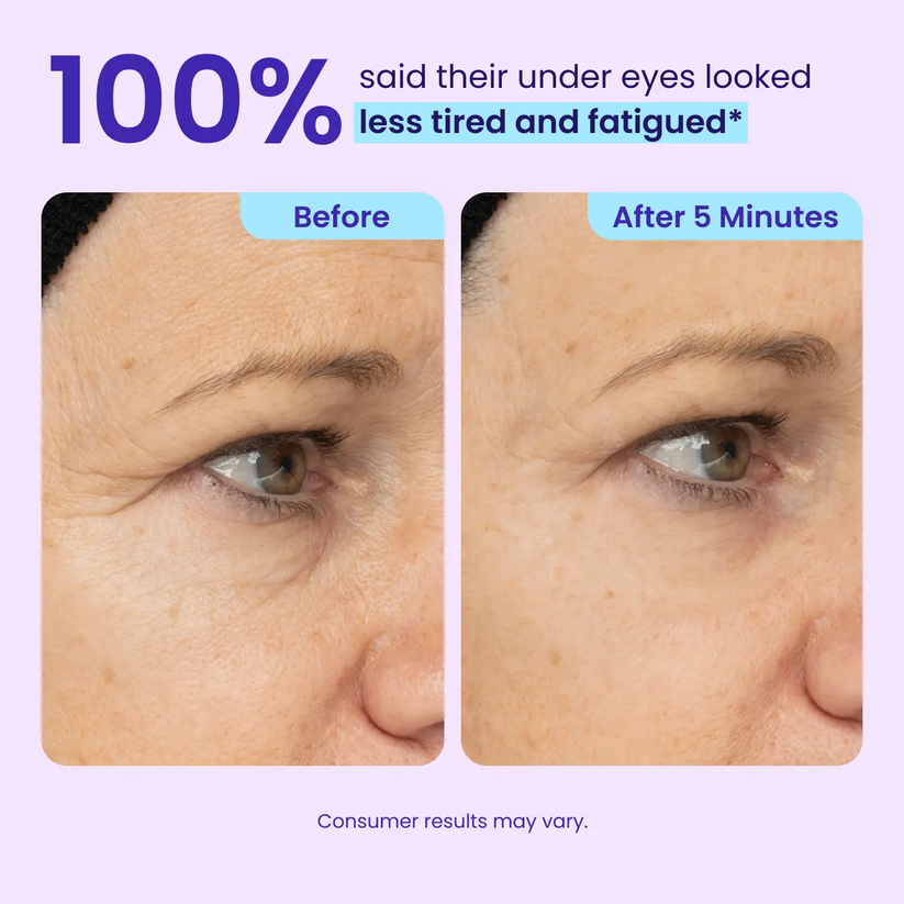 🎁Today’s Special Offer | ELVYRA™ Instant Eye Lift Eraser–Visibly Tighten, Firm & Blur Wrinkles